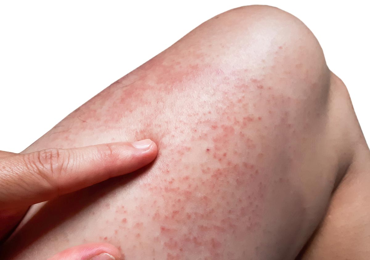 What Does A Food Allergy Rash Look Like