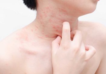 can egg allergy cause skin rash