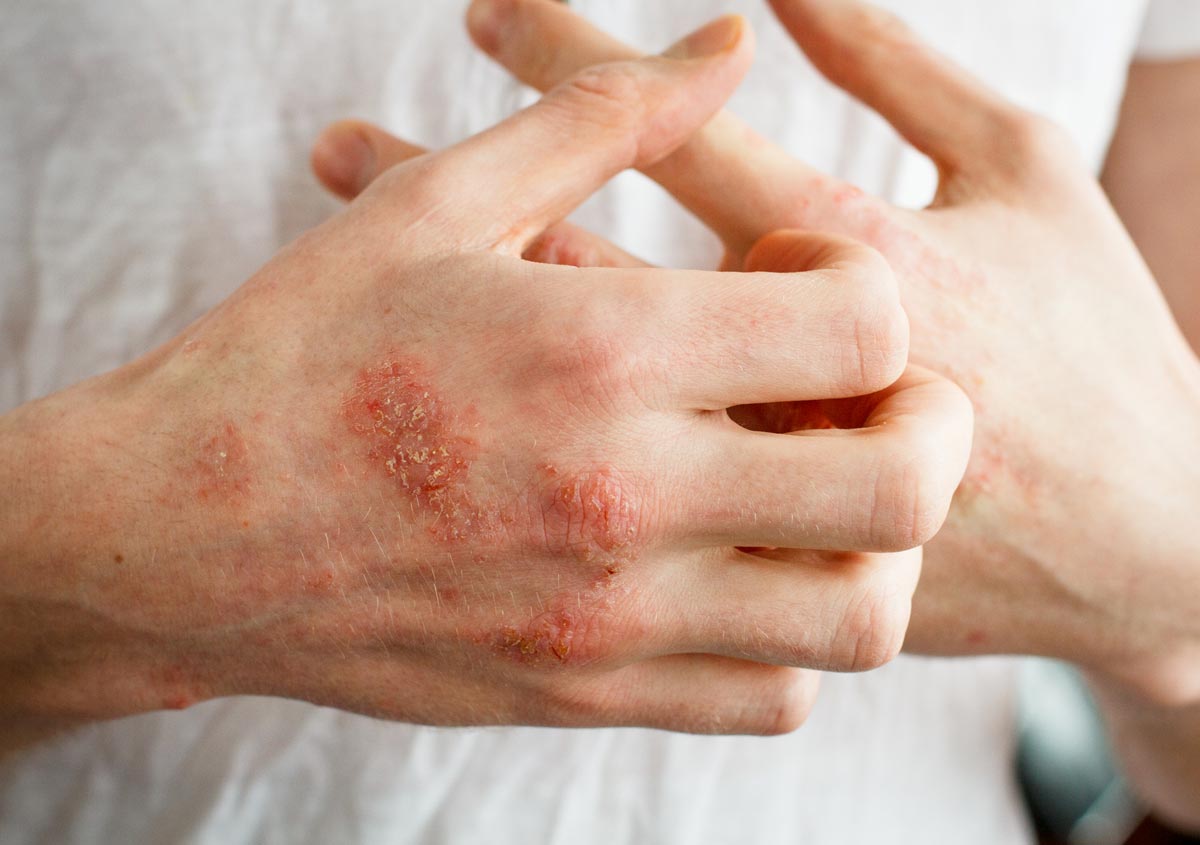 Understanding and Treating Eczema in Illinois 