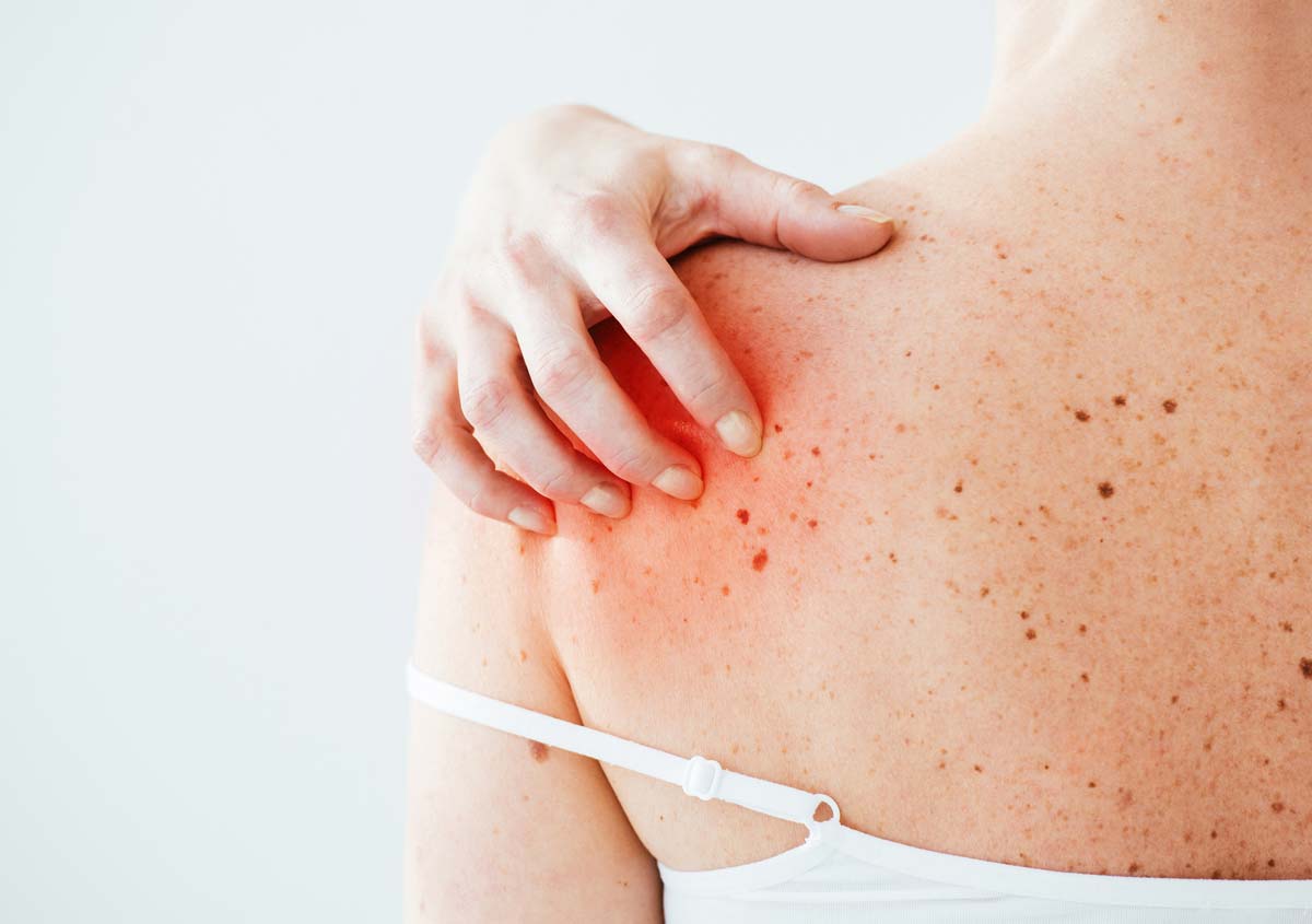 can lisinopril cause hives and itching