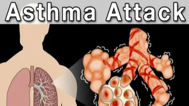Video: What is Asthma?